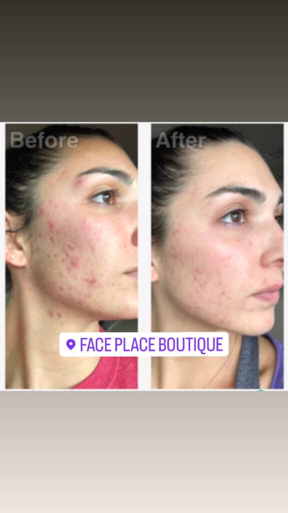 before and after of woman's face when using Face Place Boutique