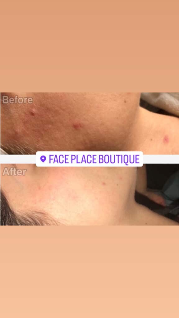 before and after of skin when using Face Place Boutique